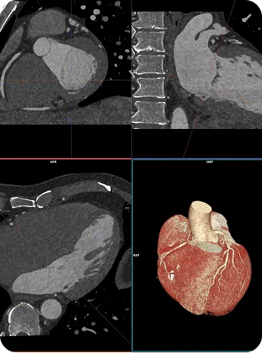 Tvärsnitt av hjärtat med calcium score från datortomografi